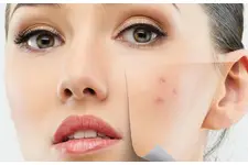 Sivilce Oluşumunu Artıran Faktörler