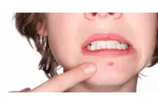 Sivilce Patlatmak Zararlı mıdır?