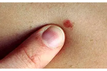 Bacaklarda Sivilce Nedenleri ve Tedavisi