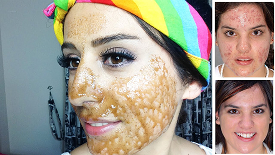 Ballı Sivilce Maskesi Hazırlanışı ve Uygulanışı