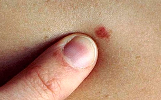 Cilt Kanseri Belirtileri ve Tedavisi