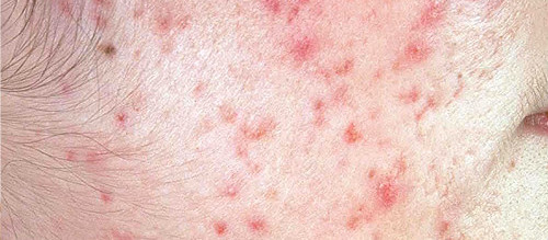 Sivilce Çeşitleri ve Özellikleri