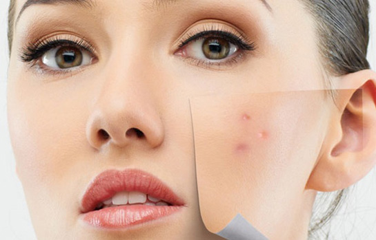 Sivilce Oluşumunu Artıran Faktörler